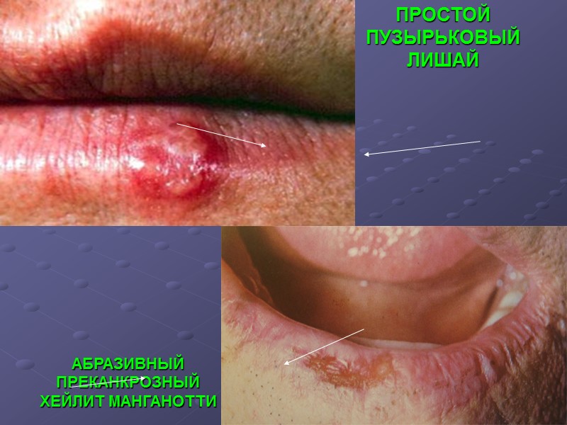 ПРОСТОЙ ПУЗЫРЬКОВЫЙ ЛИШАЙ  АБРАЗИВНЫЙ ПРЕКАНКРОЗНЫЙ  ХЕЙЛИТ МАНГАНОТТИ